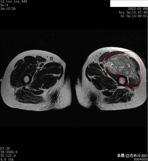 中年女性，兩年連續多次預警不重視，再次檢查發現腫瘤已是晚期了
