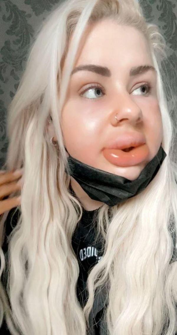 英國24歲女子第一次豐唇腫成&OpenCurlyDoubleQuote;香腸嘴&rdquo;，填充物膨脹到原來的20倍