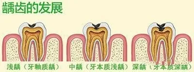 過年最怕牙疼！牙齒上突然出現小黑點是怎麼回事？