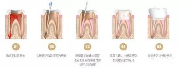 4歲寶寶被告知要做根管治療,難道遇到了“庸醫” 4歲寶寶被告知要做根管治療,難道遇到了“庸醫”