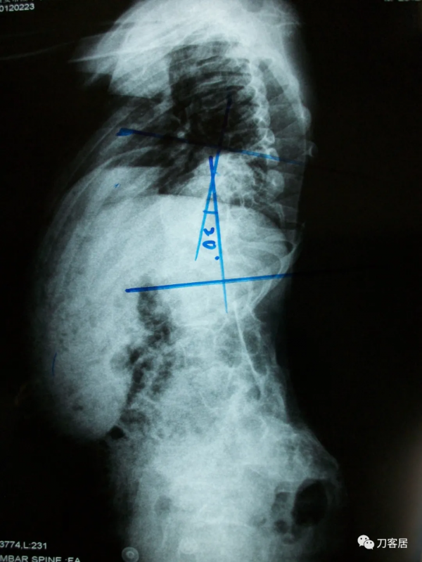 惡性高熱第3例：12歲，脊柱側彎，矯形術後死亡