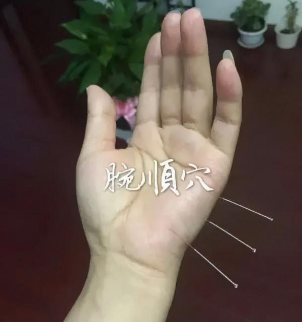 董氏奇穴治療“閃腰”經驗方