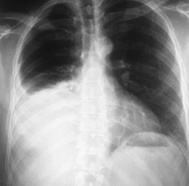 經皮腎鏡取石術的併發症 經皮腎鏡取石術的併發症