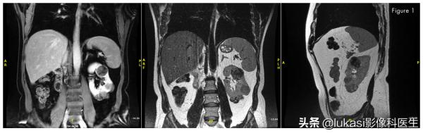 單個腎臟並且長了13個腫瘤，上帝之手給他做了自體腎移植。震撼