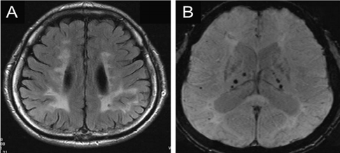 磁共振上出現腦微出血,這11種病因要考慮 磁共振上出現腦微出血,這11種病因要考慮