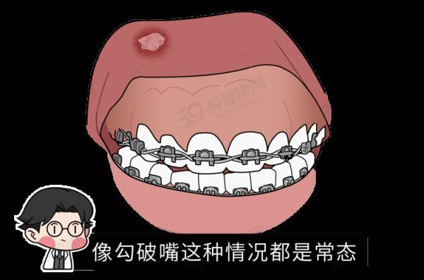 為什麼只要戴牙套,牙齒就可以恢復得很整齊?生動展示矯正過程 為什麼只要戴牙套,牙齒就可以恢復得很整齊?生動展示矯正過程