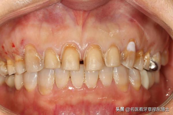 美麗前牙再煥發青春