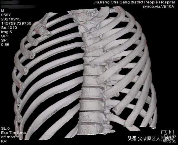 咳嗽也能導致骨折？