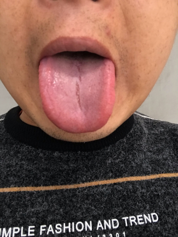 男子眩暈,右耳耳鳴,疑為高血壓,多次治療無效。醫生:看錯科了 男子眩暈,右耳耳鳴,疑為高血壓,多次治療無效。醫生:看錯科了