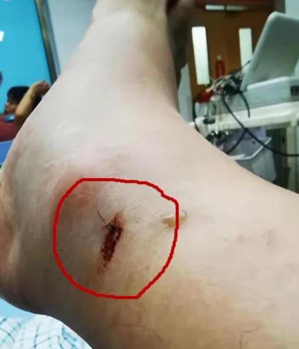 命大！浙江男子被五步蛇烙鐵頭咬傷，自救成功，它的毒性有多強？