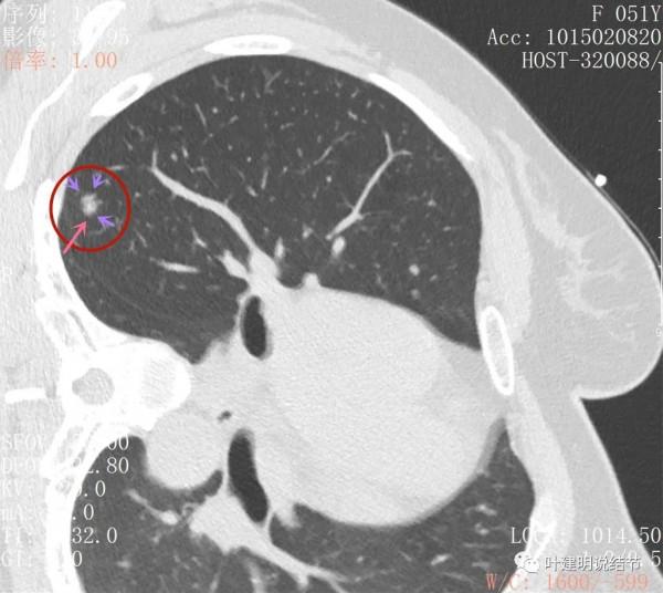 指南說小於5毫米的肺結節不需要隨訪，打臉來了