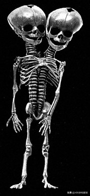 印度母牛生出雙頭小牛，主人用奶瓶喂，一個嘴巴吸奶另一個也在動