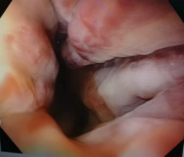 肝硬化患者,小心吃出來的出血 肝硬化患者,小心吃出來的出血