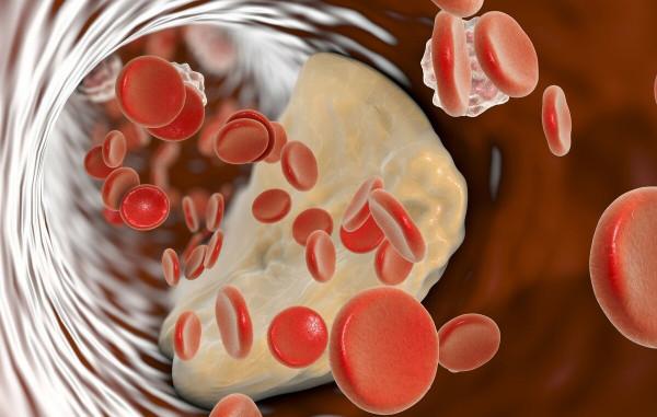 冠心病需要多藥聯合治療,哪種藥物更重要?核心用藥不能停 冠心病需要多藥聯合治療,哪種藥物更重要?核心用藥不能停