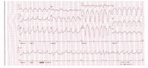 室性心律失常的新進展,你瞭解多少?|GW-ICC 2021 室性心律失常的新進展,你瞭解多少?|GW-ICC 2021