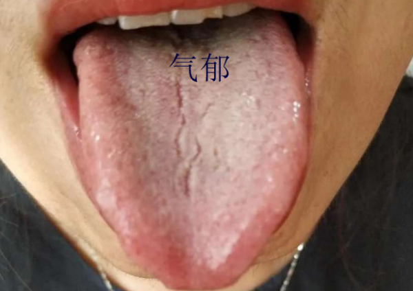 舌頭有裂紋就是陰虛嗎?教你形象地認識四種裂紋舌,十種舌象 舌頭有裂紋就是陰虛嗎?教你形象地認識四種裂紋舌,十種舌象