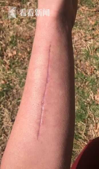 女子舉167公斤深蹲當場斷臂 骨頭差點刺穿面板