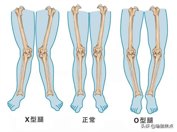 練瑜伽，什麼是&quot;X／O&quot;型腿？如何矯正？（收藏級）