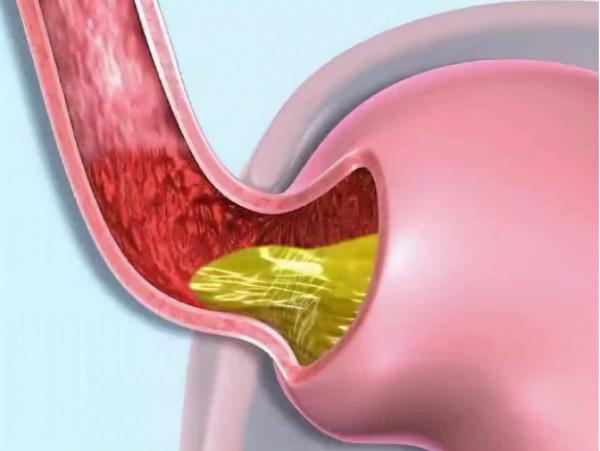 奧美拉唑、蘭索拉唑、泮托拉唑、雷貝拉唑有何區別？哪個作用最好