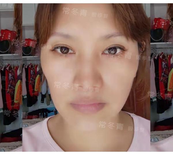 雙眼皮修復 | 常見的3種需要修復情況:寬假深、上瞼凹陷,不對稱 雙眼皮修復 | 常見的3種需要修復情況:寬假深、上瞼凹陷,不對稱