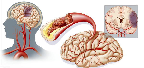 2箇中成藥，降脂化濁、抑制斑塊生成、打通血脈，抗冠心病和腦梗