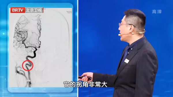 頭暈頭沉、反應力下降？可能是頸動脈出了大問題！2個檢查早發現