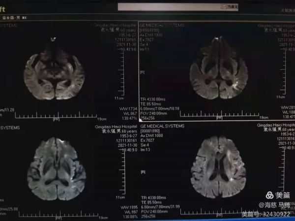 打通大腦“老堵點”神經介入科微創開通顱內慢性閉塞
