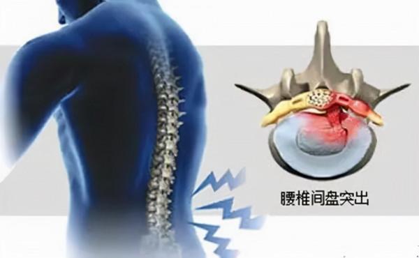 腰腿痛的病因，全在這裡了！（乾貨收藏）