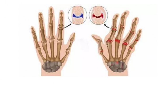 手指“咔咔”響，很有成就感？其實它可能在提醒你小心這些疾病