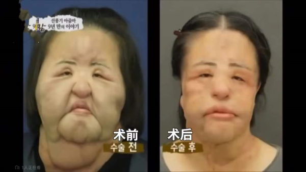 “整容上癮”韓慧景：把臉整成電風扇，自行注射食用油，代價慘痛