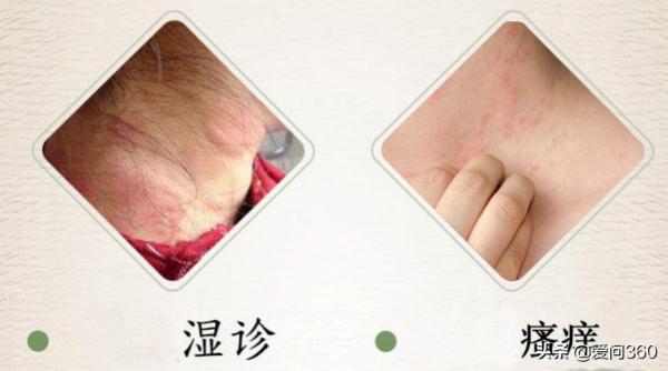 溼疹癢得難受,小妙招幫你解憂,告別反覆發作的溼疹 溼疹癢得難受,小妙招幫你解憂,告別反覆發作的溼疹