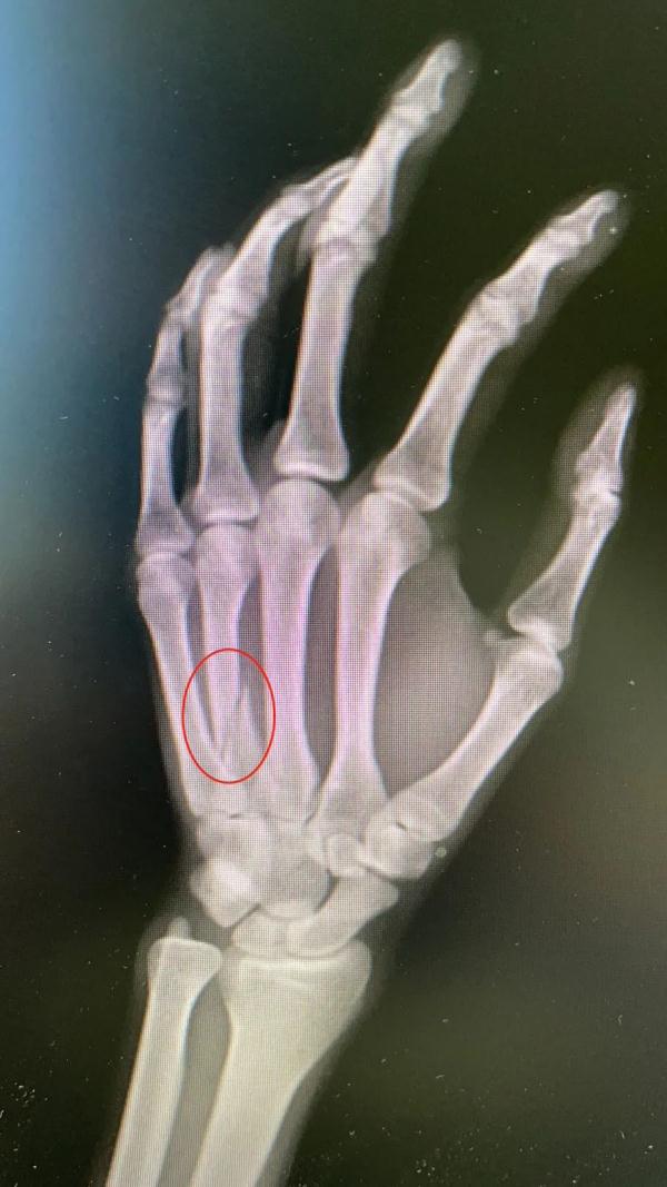 兒子寫作業時玩手機，爸爸一拳揮過去，啪一聲，骨折了……