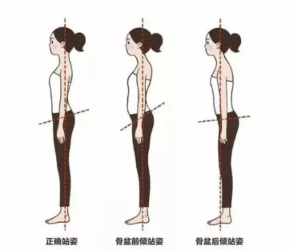 骨盆前傾危害大!4種練習緩解你的骨盆前傾 骨盆前傾危害大!4種練習緩解你的骨盆前傾