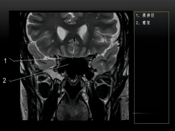MRI下眼部及鼻竇解剖