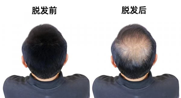 脫髮還有救！千萬別放棄啊