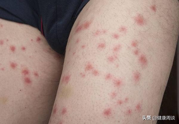 痱子與溼疹有哪些不同？主要有4方面，其實不難分辨