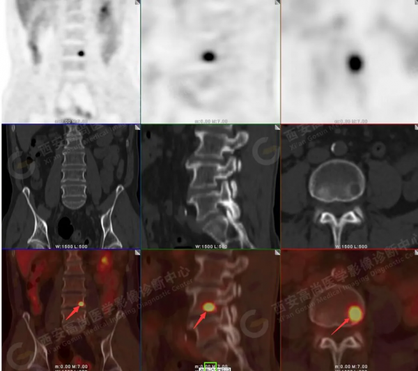 肺結節看診（13）：肺小結節全身廣泛轉移2例，PET分期：晚期