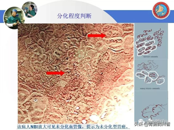 早期胃癌——內鏡診治流程