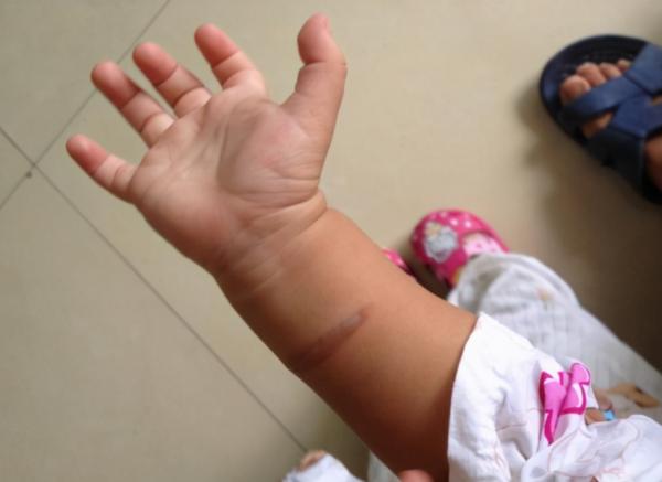 孩子被沸水燙傷，家長需謹記五字訣救治，處理不當會害娃