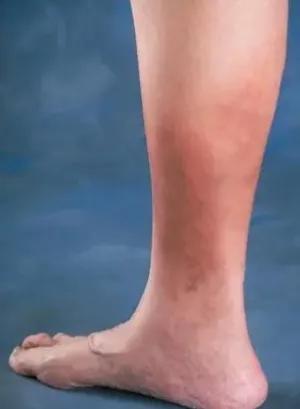 五體痺中脈痺如何治療呢? 五體痺中脈痺如何治療呢?