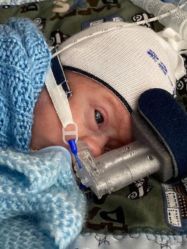 倆胎兒在媽媽子宮裡搶食，弟弟出生時不到1斤重，奇蹟般活了下來