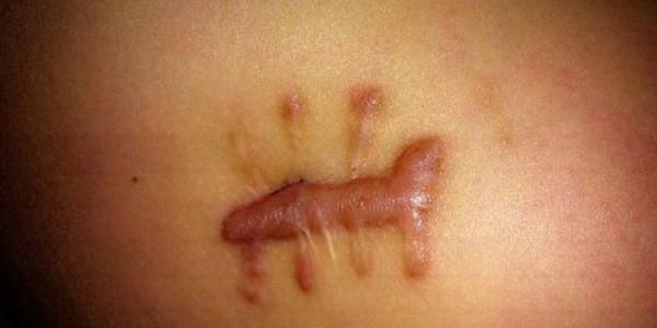 增生性凸疤祛除最有效的方法是什麼? 增生性凸疤祛除最有效的方法是什麼?