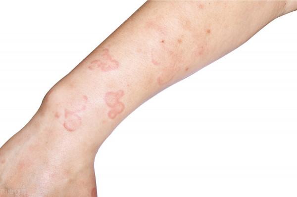 中醫治療蕁麻疹 常用的2種中成藥!你知道嗎? 中醫治療蕁麻疹 常用的2種中成藥!你知道嗎?