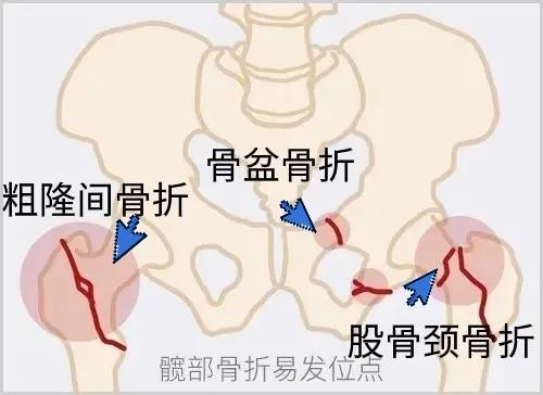 家有老人請注意，“人生最後一次骨折”，年死亡率可達50%