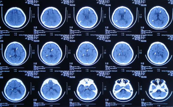 顱內生殖細胞瘤切除術後腦積水仍反覆,意識模糊,左側肢體偏癱 顱內生殖細胞瘤切除術後腦積水仍反覆,意識模糊,左側肢體偏癱