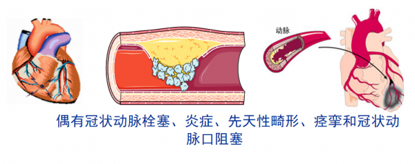 急性心肌梗死（一）