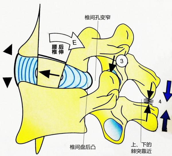 燕飛式-腰部後伸鍛鍊方式的缺陷