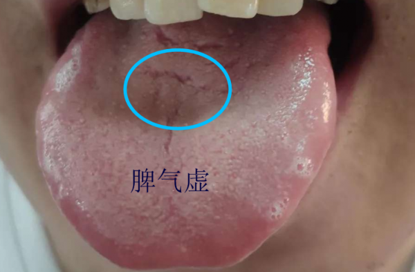 舌頭有裂紋就是陰虛嗎?教你形象地認識四種裂紋舌,十種舌象 舌頭有裂紋就是陰虛嗎?教你形象地認識四種裂紋舌,十種舌象