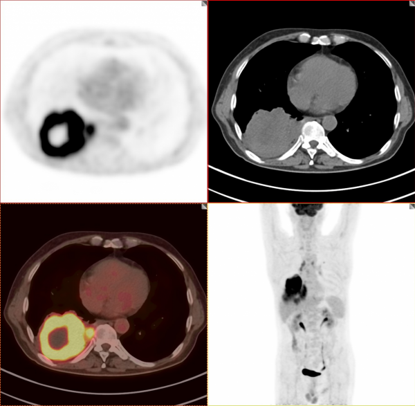 PET/CT病例（1）：晚期肺癌治療3個月，老人重現希望和曙光