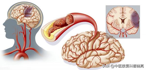 糖尿病也會引起麻木嗎？出現手腳麻木可能是什麼病